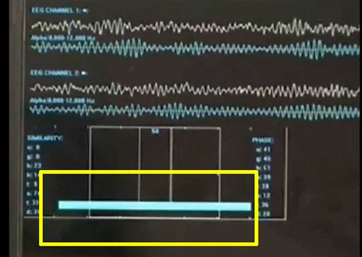 024-eeg-after.jpg - When Dr Hea began the Transcendental Meditation Programme there was a powerful change to 85% brain wave coherence from ?waking state?s' usual 30 ? 35% coherence.