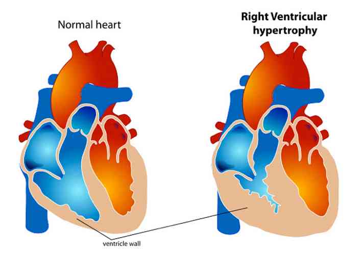 11-VentricularHypertrophy.jpg - Effects of the Transcendental Meditation technique on reduction of left ventricular mass.  Left ventricular hypertrophy is one of the major predictors of cardiovascular disease, in which the muscles of the heart become overworked, creating an unhealthy effect on the heart.